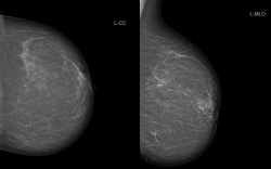Рентгеновская цифровая маммография 